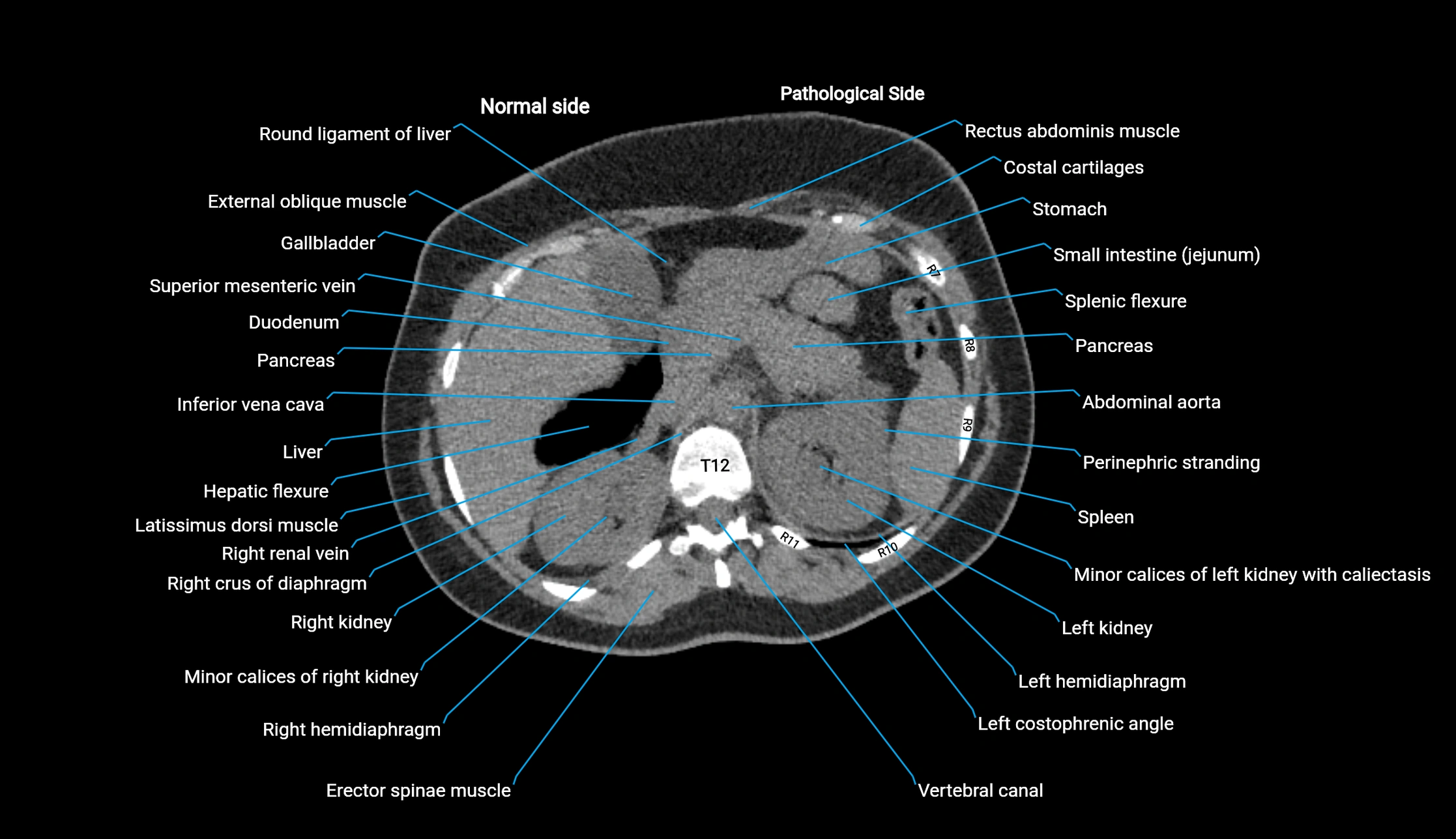 CT KUB axial cross sectional anatomy  radiology image -img-00201-00026.webp